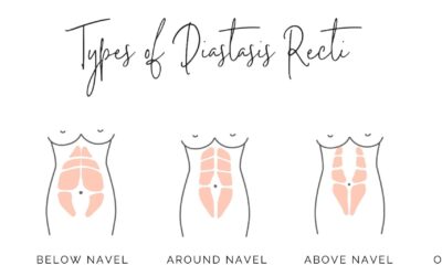 Mommy Belly: Understanding Diastasis Recti and Embracing the Journey Back to Core Strength