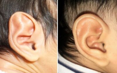 Dr. Shareef Jandali: Infant Ear Molding