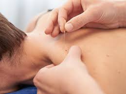 What’s The BUZZ Around Dry Needling And Can It Help Me?